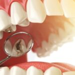 Dr. Kami Hoss Elaborates on Enhancing Molar Protection Through Sealants
