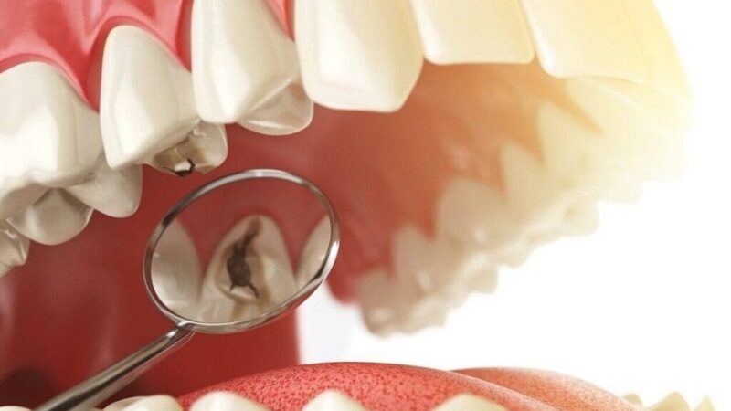 Dr. Kami Hoss Elaborates on Enhancing Molar Protection Through Sealants