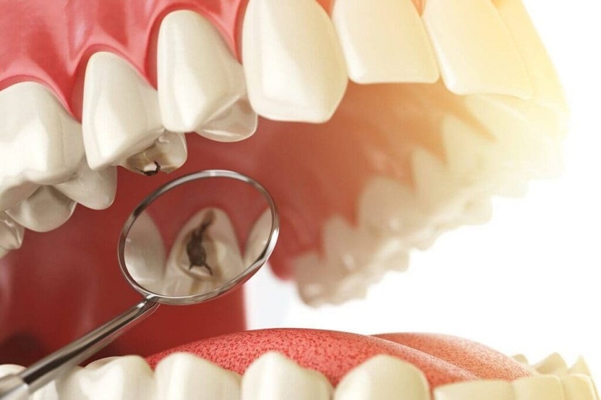 Molar Protection Through Sealants